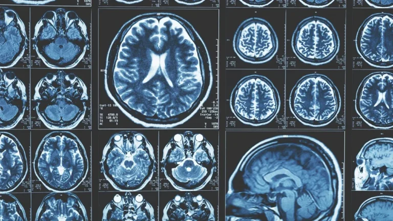 Alzheimer Araştırmalarında Beyin Dışına Dönüş: T Hücreleri ve Lenf Düğümleri Öne Çıkıyor