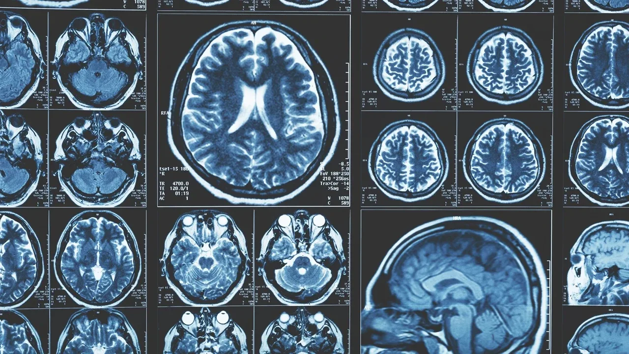 Alzheimer Araştırmalarında Beyin Dışına Dönüş: T Hücreleri ve Lenf Düğümleri Öne Çıkıyor